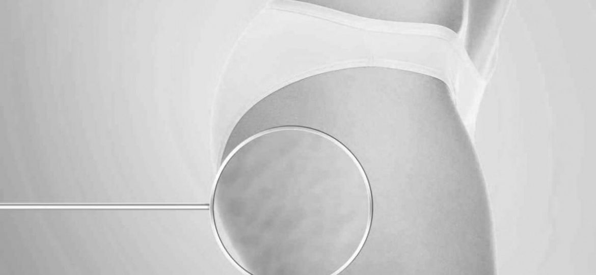 Celulitis en mujer