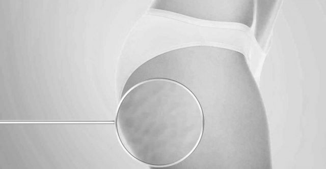 Celulitis en mujer