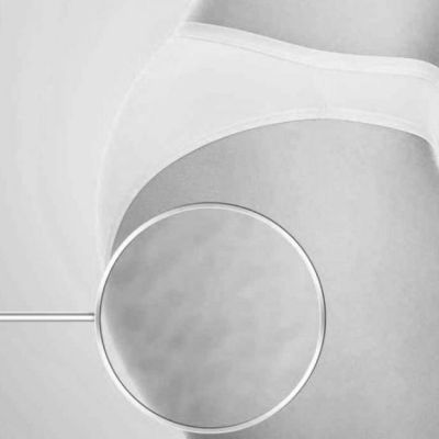 Celulitis en mujer
